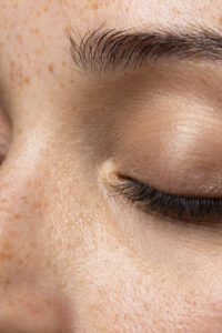 best cleansers for acne-prone skin